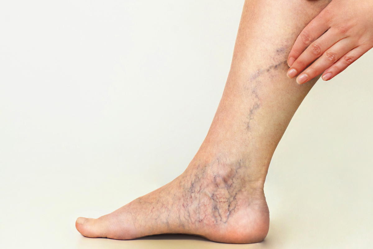 Top 5 Myths About Spider Veins Debunked